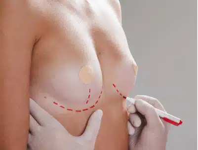 borstvergroting-behandeling