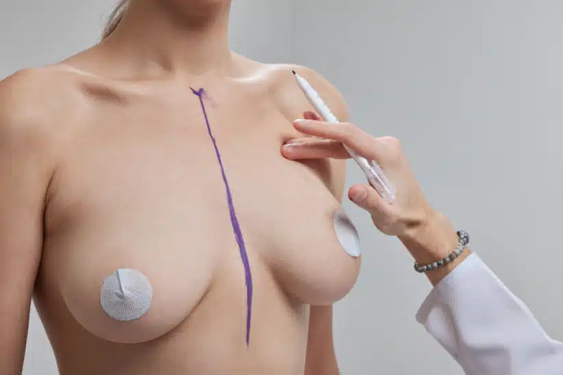 breast reduction