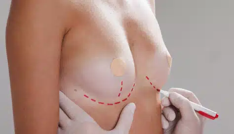 doctor-drawing-marks-on-female-breast-before-cosme-2024-09-21-00-26-13-utc 2