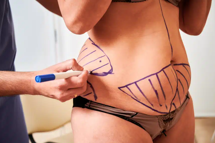 plastic-surgeon-marking-woman-body-in-clinic-2025-01-17-00-12-25-utc 1